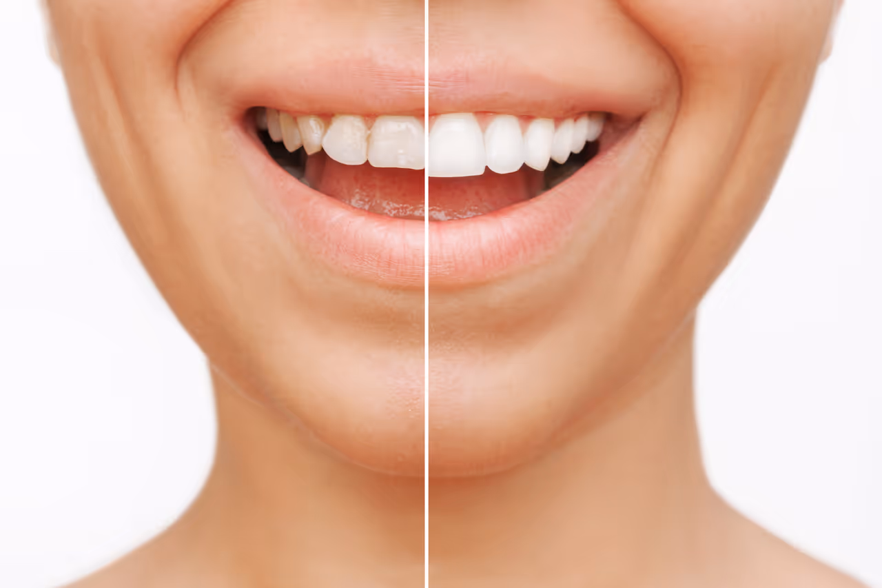 Veneer shade-matching against a patient's natural tooth color